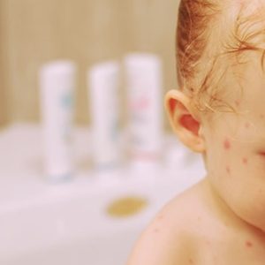 Чи можна купатися при вітрянці дітям і дорослим: правила безпечного миття